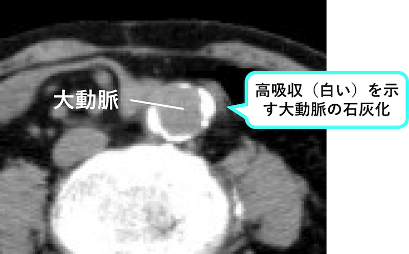 腸管の粘膜下浮腫、粘膜下層の肥厚の鑑別